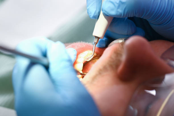 Best Emergency Dental Care for Broken or Chipped Teeth in East Providence, RI