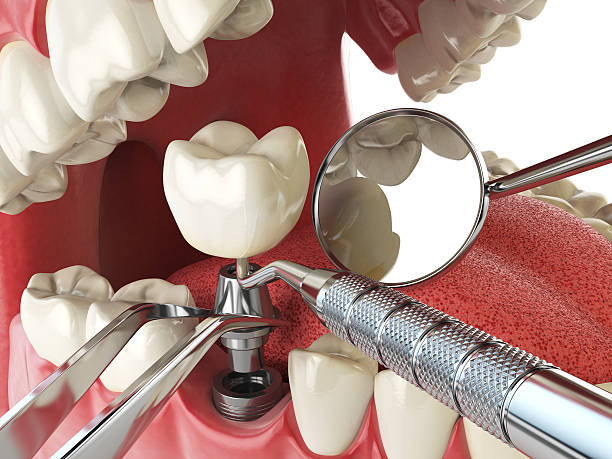 Best Emergency Dental Care for Broken or Chipped Teeth in East Providence, RI